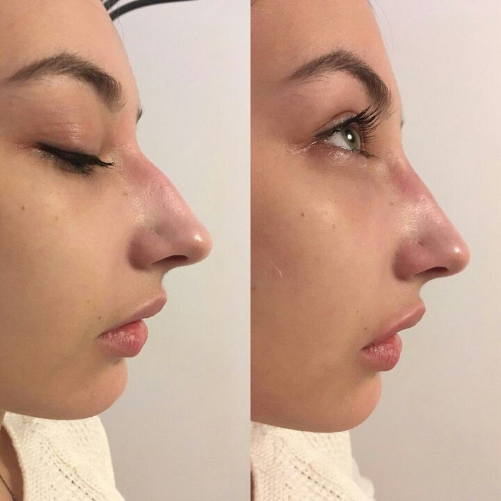 Correction of the nose