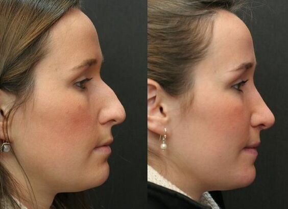 Before and after non -surgical rhinoplasty