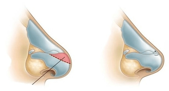 Nose shape correction