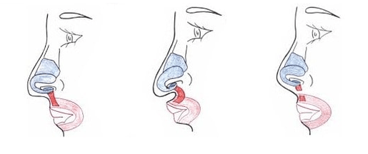 Truncation of part of the nasal muscle