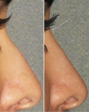 Before and after non-surgical rhinoplasty