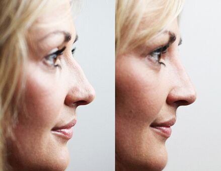 Before and after rhinoplasty with fillers