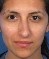 Irregular nose shape is a reason for plastic surgery