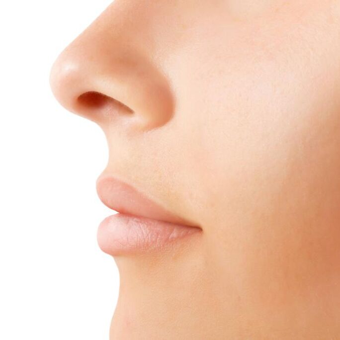 result of open rhinoplasty