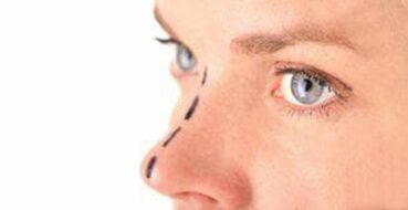 Marking on the nose for insertion of cosmetic threads