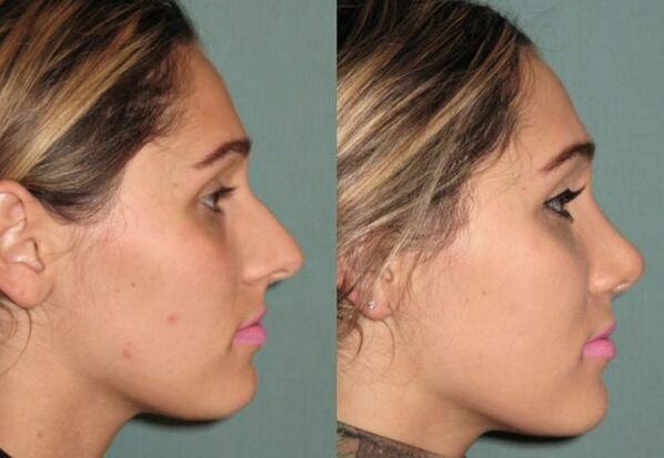 result of non-injection rhinoplasty
