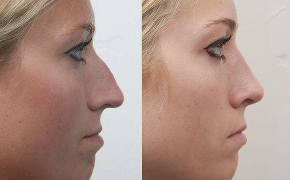 the result of rhinoplasty of the nose