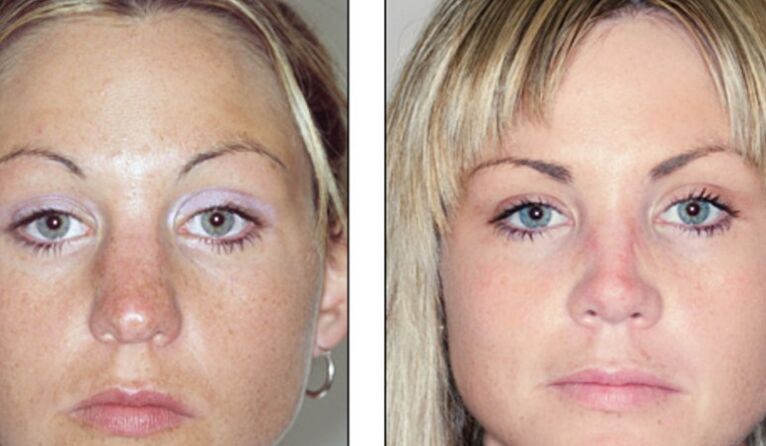 Before and after a failed nose rhinoplasty